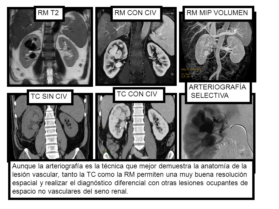 RM T2 RM CON CIV. RM MIP VOLUMEN. ARTERIOGRAFÍA. SELECTIVA. TC CON CIV. TC SIN CIV.