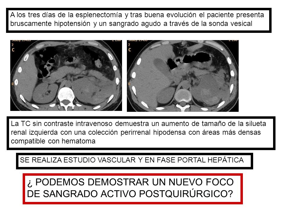 ¿ PODEMOS DEMOSTRAR UN NUEVO FOCO DE SANGRADO ACTIVO POSTQUIRÚRGICO