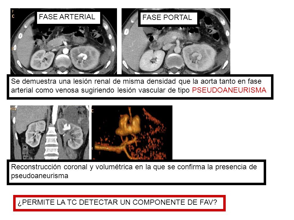 FASE ARTERIAL FASE PORTAL. Se demuestra una lesión renal de misma densidad que la aorta tanto en fase.