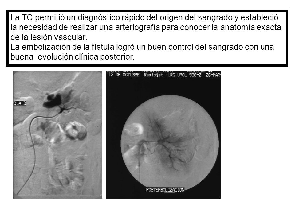 La TC permitió un diagnóstico rápido del origen del sangrado y estableció la necesidad de realizar una arteriografía para conocer la anatomía exacta de la lesión vascular.