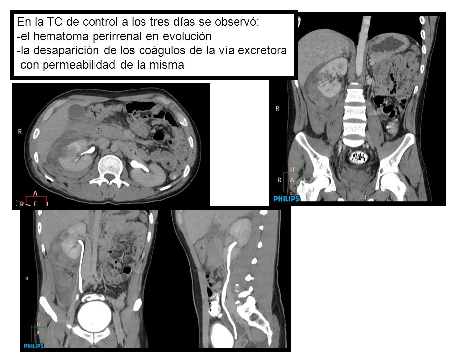 En la TC de control a los tres días se observó: