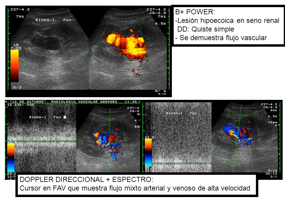 B+ POWER: -Lesión hipoecoica en seno renal. DD: Quiste simple. - Se demuestra flujo vascular. DOPPLER DIRECCIONAL + ESPECTRO: