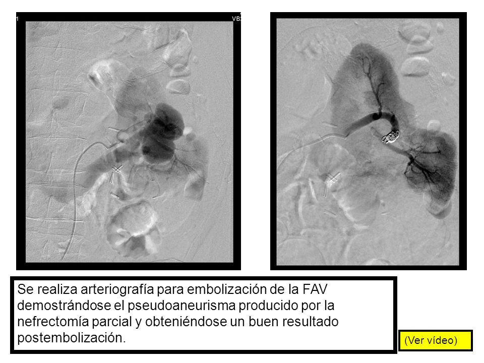 Se realiza arteriografía para embolización de la FAV demostrándose el pseudoaneurisma producido por la nefrectomía parcial y obteniéndose un buen resultado postembolización.