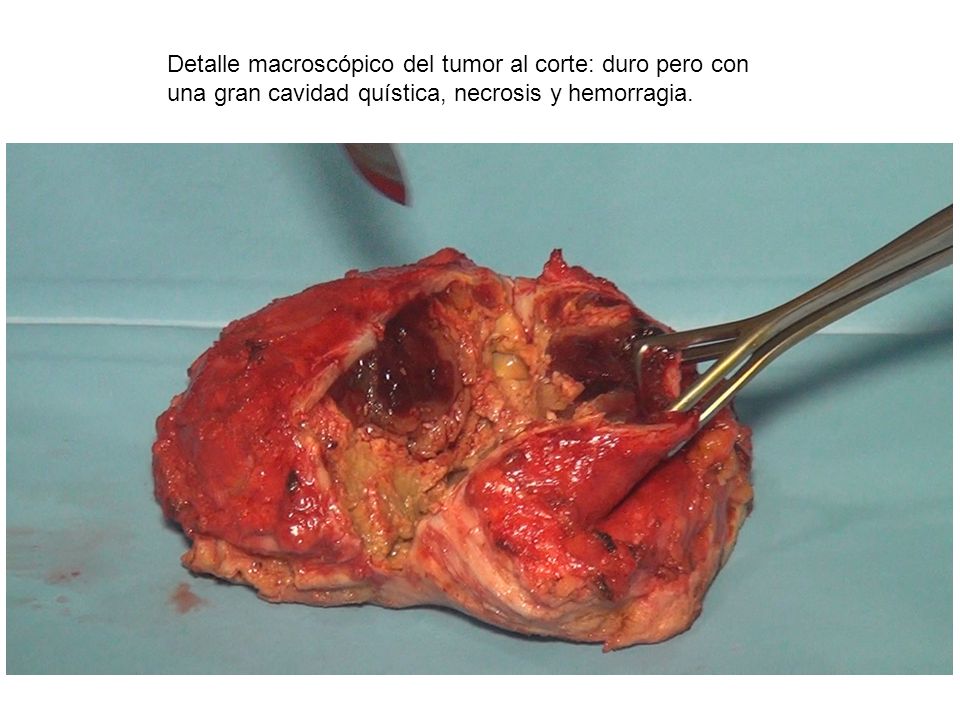 Detalle macroscópico del tumor al corte: duro pero con una gran cavidad quística, necrosis y hemorragia.