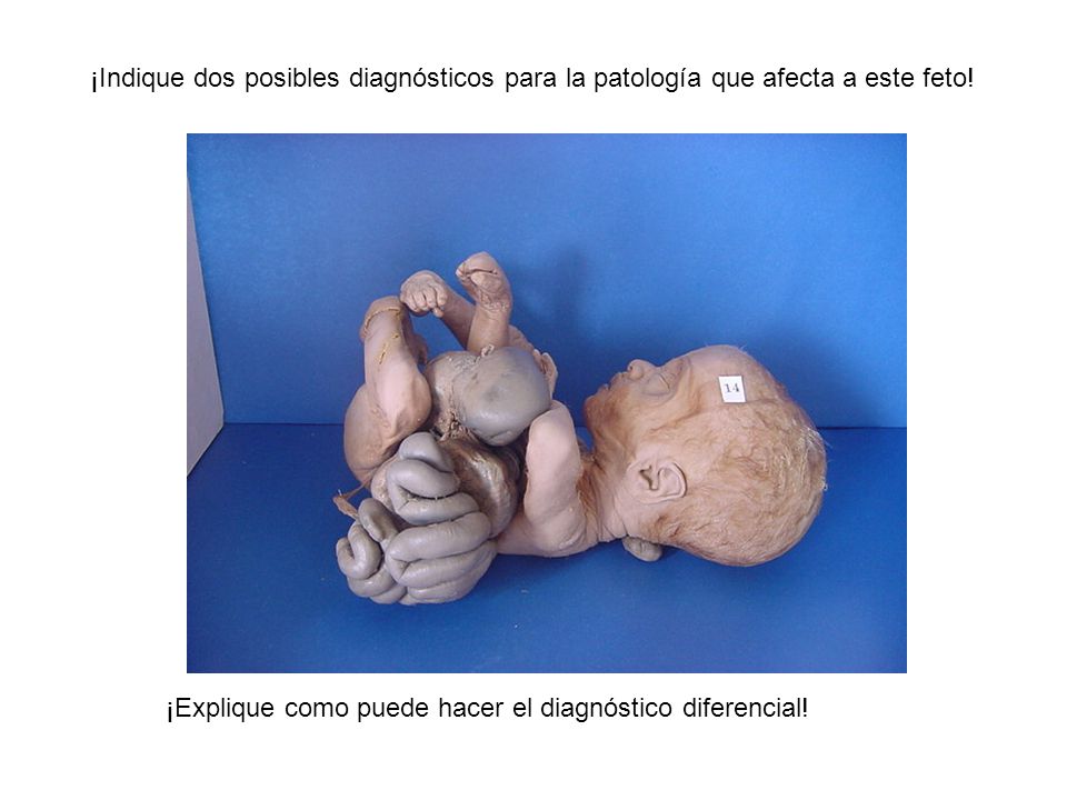 ¡Indique dos posibles diagnósticos para la patología que afecta a este feto!