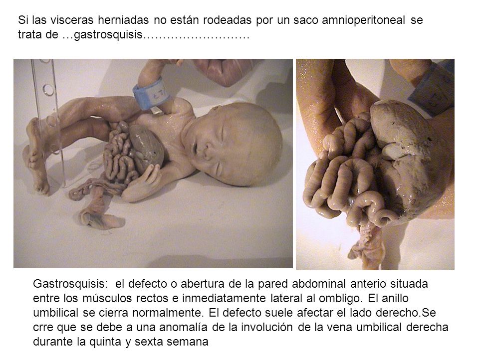 Si las visceras herniadas no están rodeadas por un saco amnioperitoneal se trata de …gastrosquisis………………………