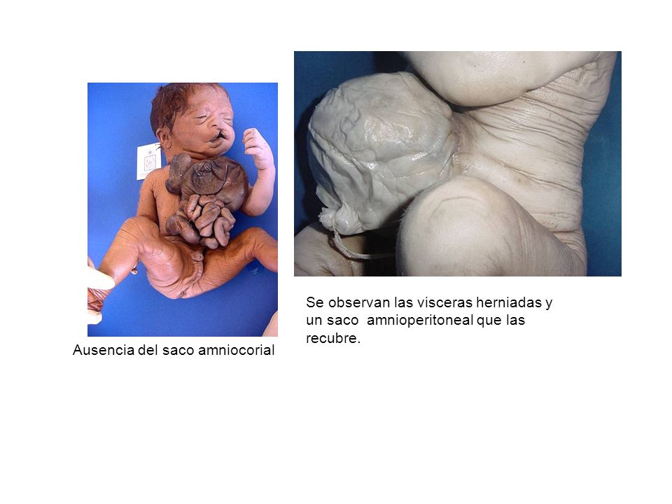 Se observan las visceras herniadas y un saco amnioperitoneal que las recubre.