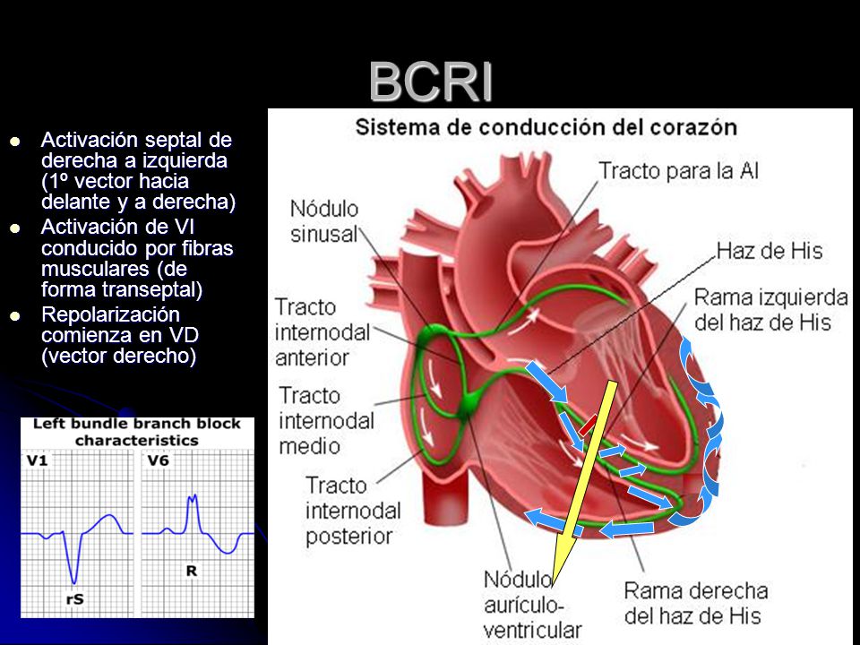 BCRI Activación septal de derecha a izquierda (1º vector hacia delante y a derecha)