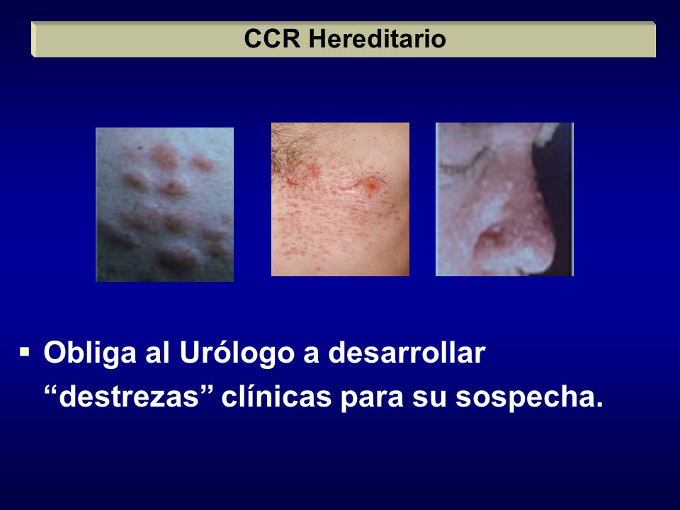 Obliga al Urólogo a desarrollar destrezas clínicas para su sospecha.