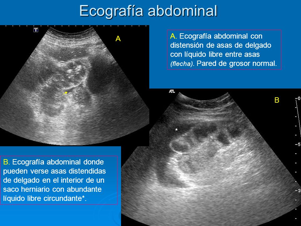 Ecografía abdominal A. Ecografía abdominal con distensión de asas de delgado con líquido libre entre asas (flecha). Pared de grosor normal.