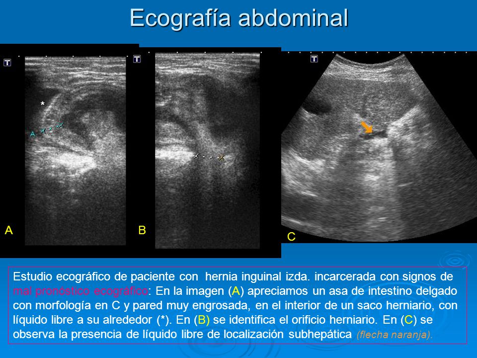 Ecografía abdominal * A B C