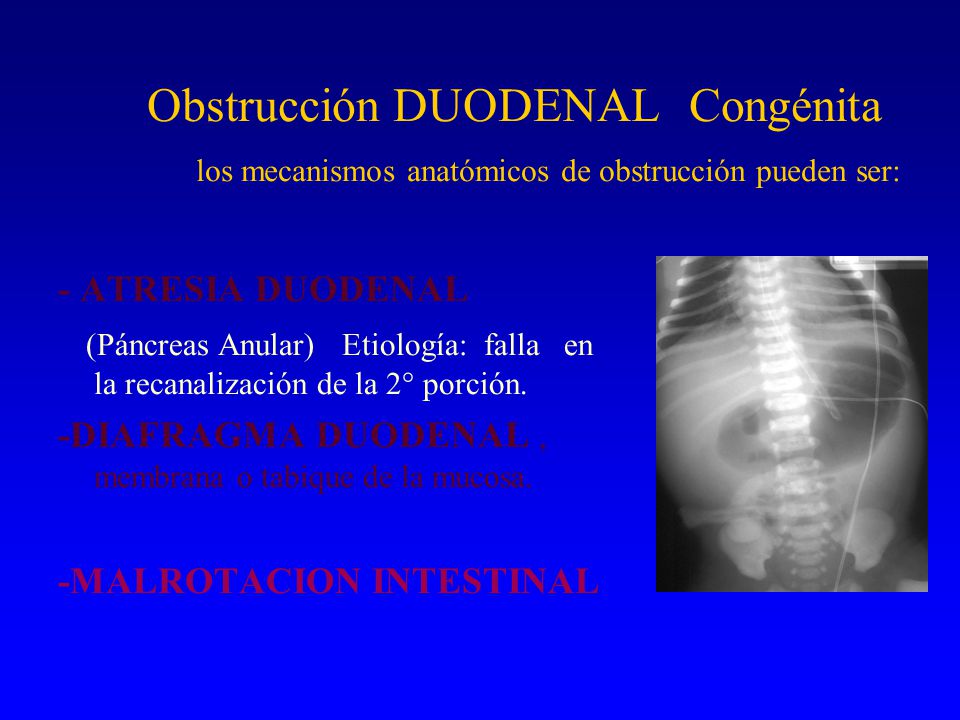Obstrucción DUODENAL Congénita los mecanismos anatómicos de obstrucción pueden ser: