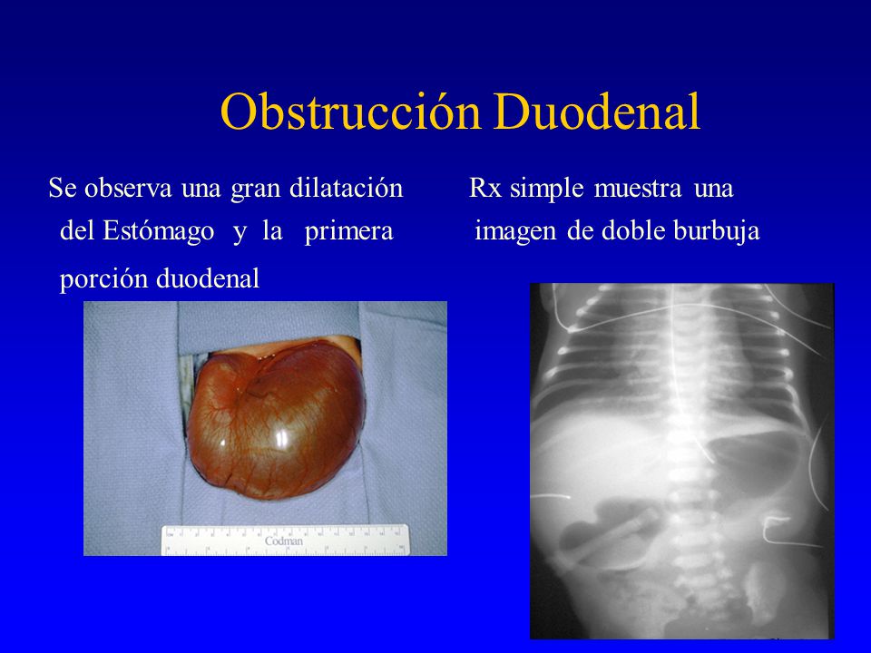 Obstrucción Duodenal Se observa una gran dilatación Rx simple muestra una. del Estómago y la primera imagen de doble burbuja.
