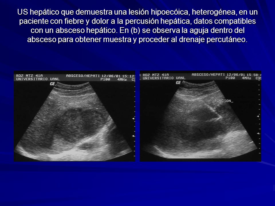 US hepático que demuestra una lesión hipoecóica, heterogénea, en un paciente con fiebre y dolor a la percusión hepática, datos compatibles con un absceso hepático.