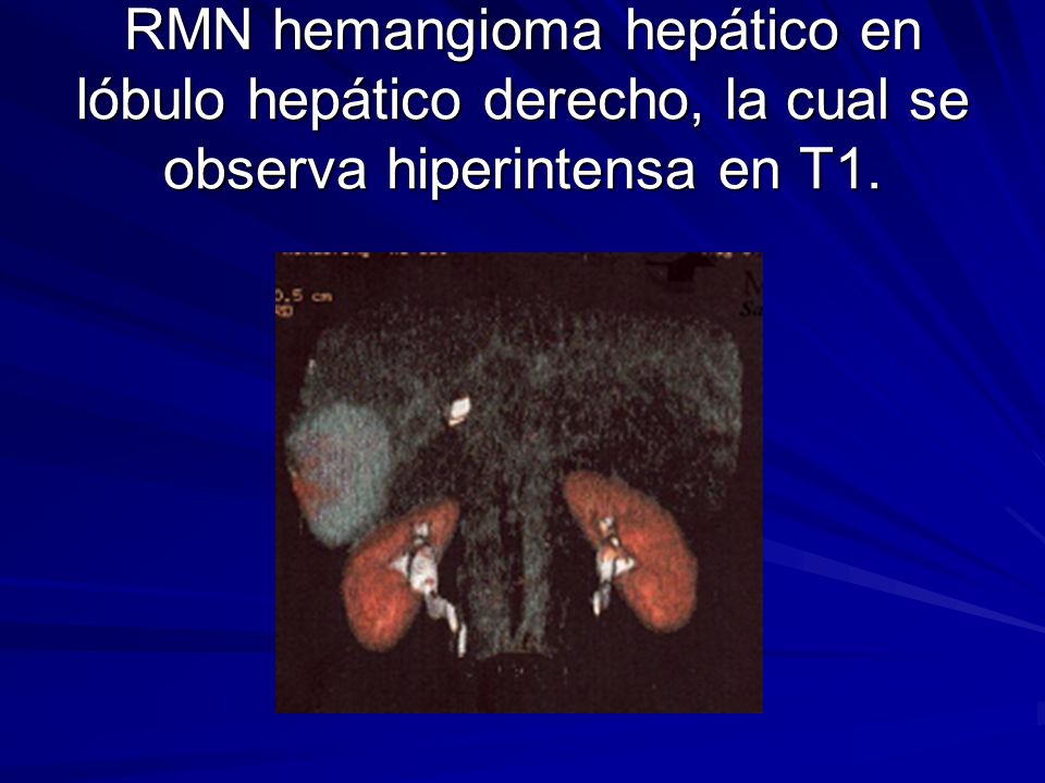 RMN hemangioma hepático en lóbulo hepático derecho, la cual se observa hiperintensa en T1.