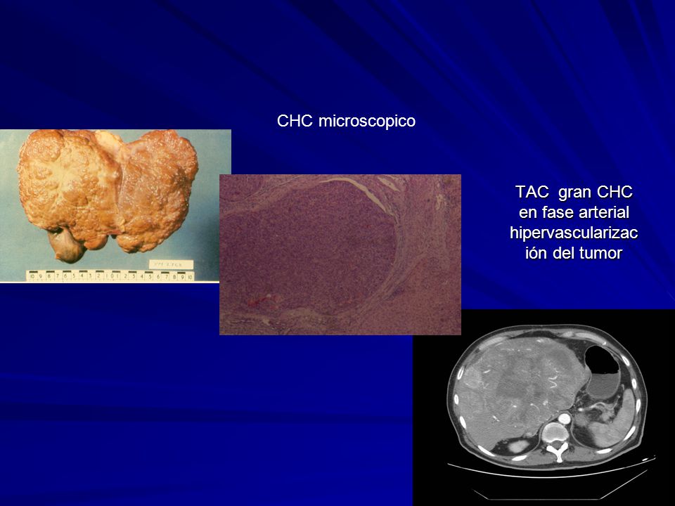 TAC gran CHC en fase arterial hipervascularización del tumor