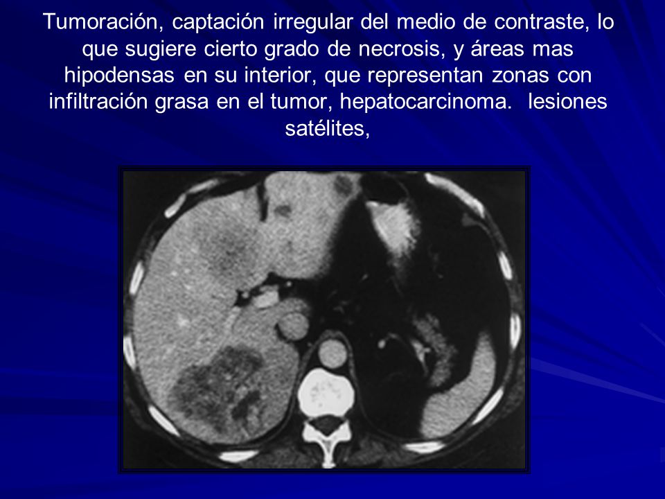 Tumoración, captación irregular del medio de contraste, lo que sugiere cierto grado de necrosis, y áreas mas hipodensas en su interior, que representan zonas con infiltración grasa en el tumor, hepatocarcinoma.