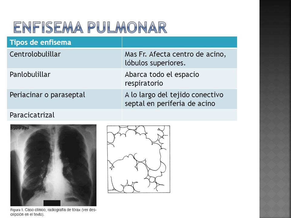 Enfisema pulmonar. - ppt video online descargar