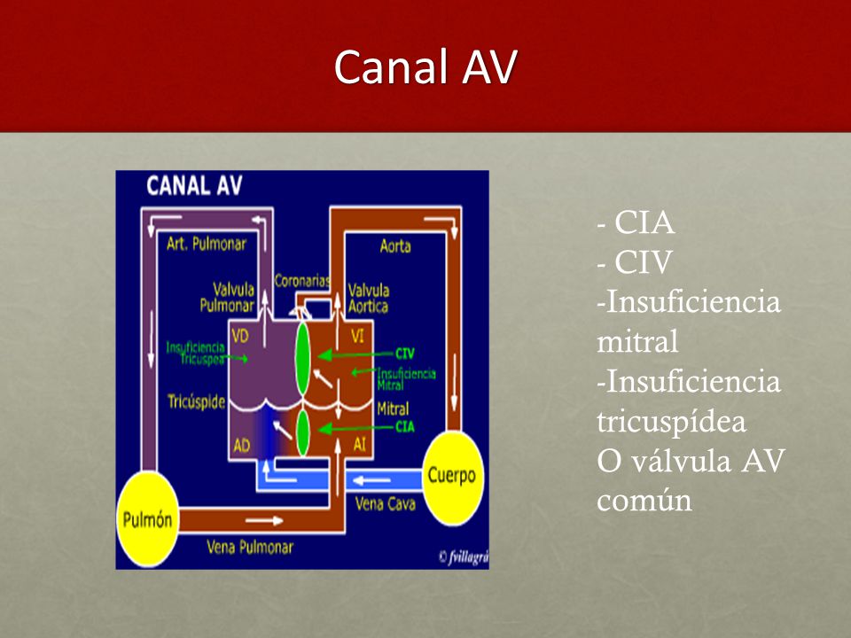 Canal AV - CIA - CIV -Insuficiencia mitral -Insuficiencia tricuspídea