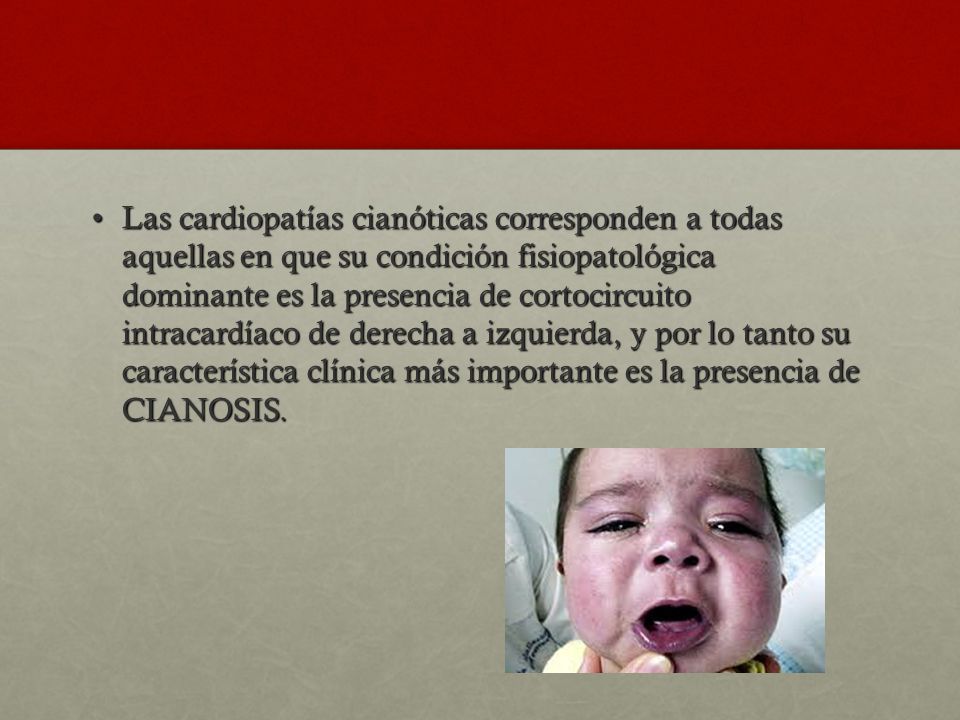 Las cardiopatías cianóticas corresponden a todas aquellas en que su condición fisiopatológica dominante es la presencia de cortocircuito intracardíaco de derecha a izquierda, y por lo tanto su característica clínica más importante es la presencia de CIANOSIS.