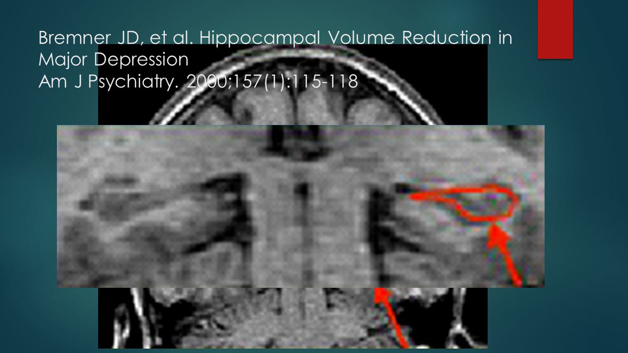 Bremner JD, et al. Hippocampal Volume Reduction in Major Depression Am J Psychiatry.