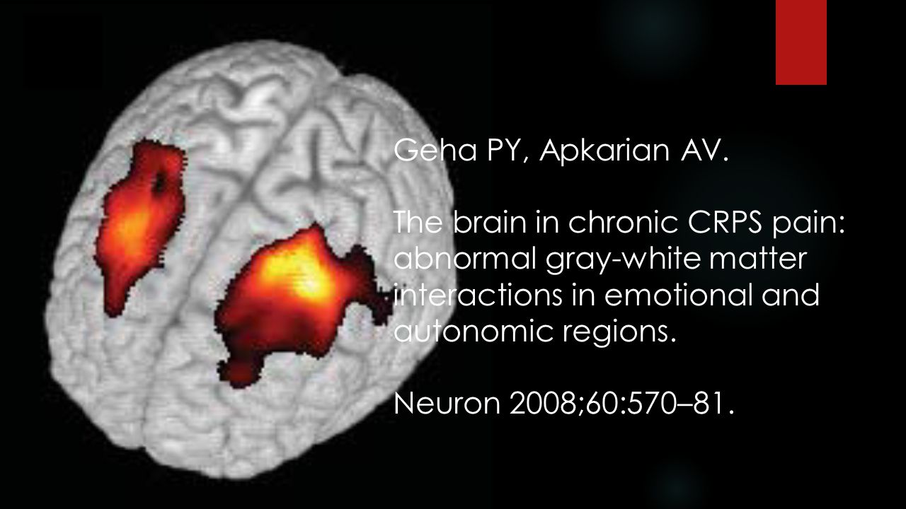 Geha PY, Apkarian AV. The brain in chronic CRPS pain: abnormal gray-white matter interactions in emotional and autonomic regions.