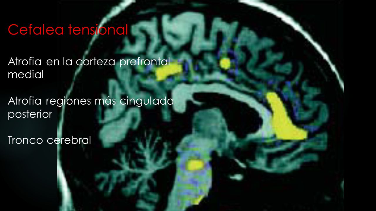 Cefalea tensional Atrofia en la corteza prefrontal medial