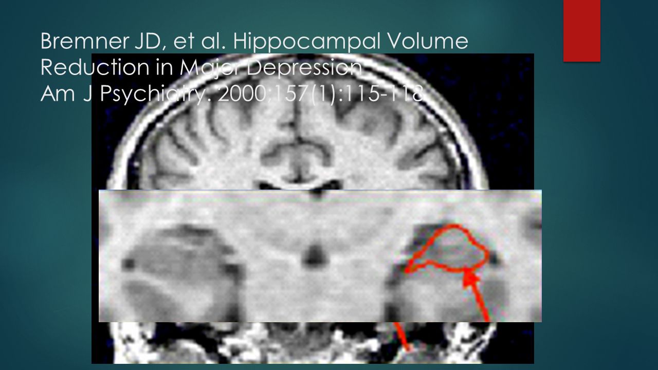 Bremner JD, et al. Hippocampal Volume Reduction in Major Depression Am J Psychiatry.
