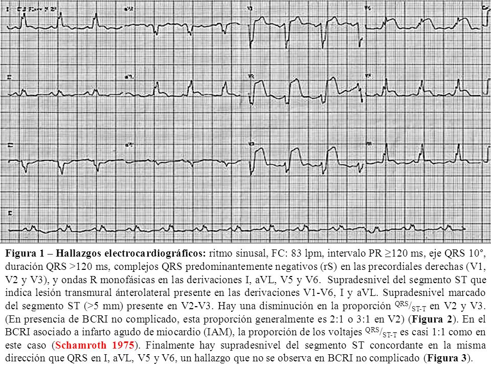 Figura 1 – Hallazgos electrocardiográficos: ritmo sinusal, FC: 83 lpm, intervalo PR ≥120 ms, eje QRS 10°, duración QRS >120 ms, complejos QRS predominantemente negativos (rS) en las precordiales derechas (V1, V2 y V3), y ondas R monofásicas en las derivaciones I, aVL, V5 y V6.