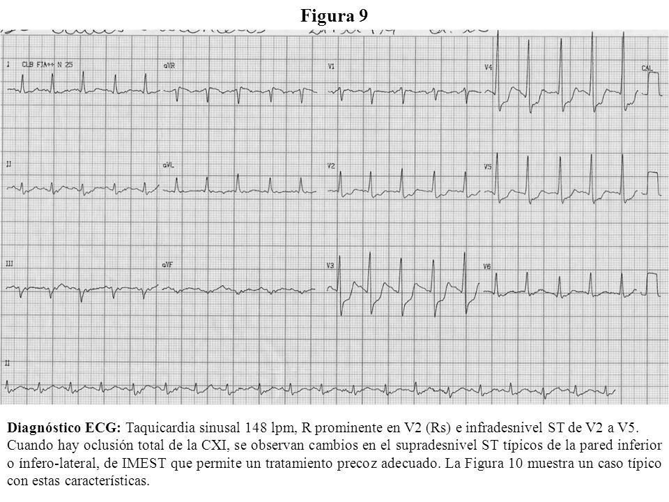 Figura 9 Diagnóstico ECG: Taquicardia sinusal 148 lpm, R prominente en V2 (Rs) e infradesnivel ST de V2 a V5.