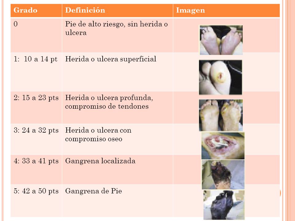 Grado Definición. Imagen. Pie de alto riesgo, sin herida o ulcera. 1: 10 a 14 pt. Herida o ulcera superficial.