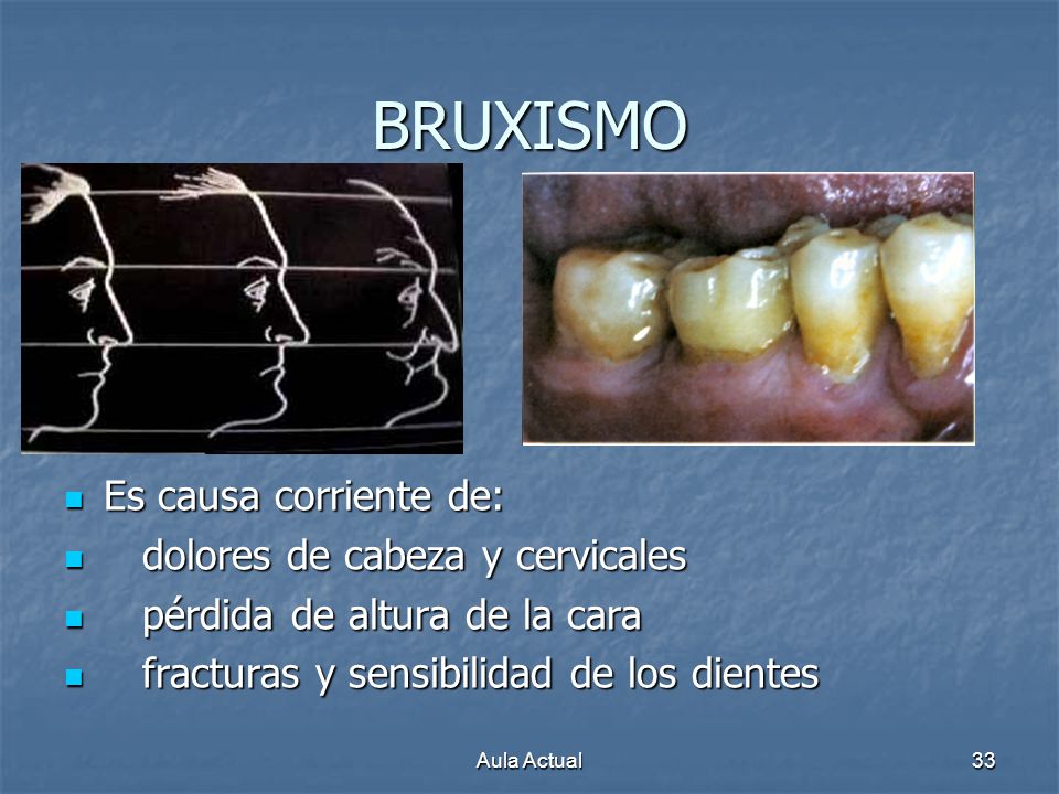 BRUXISMO Es causa corriente de: dolores de cabeza y cervicales