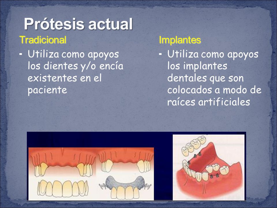 Tradicional Utiliza como apoyos los dientes y/o encía existentes en el paciente. Implantes.