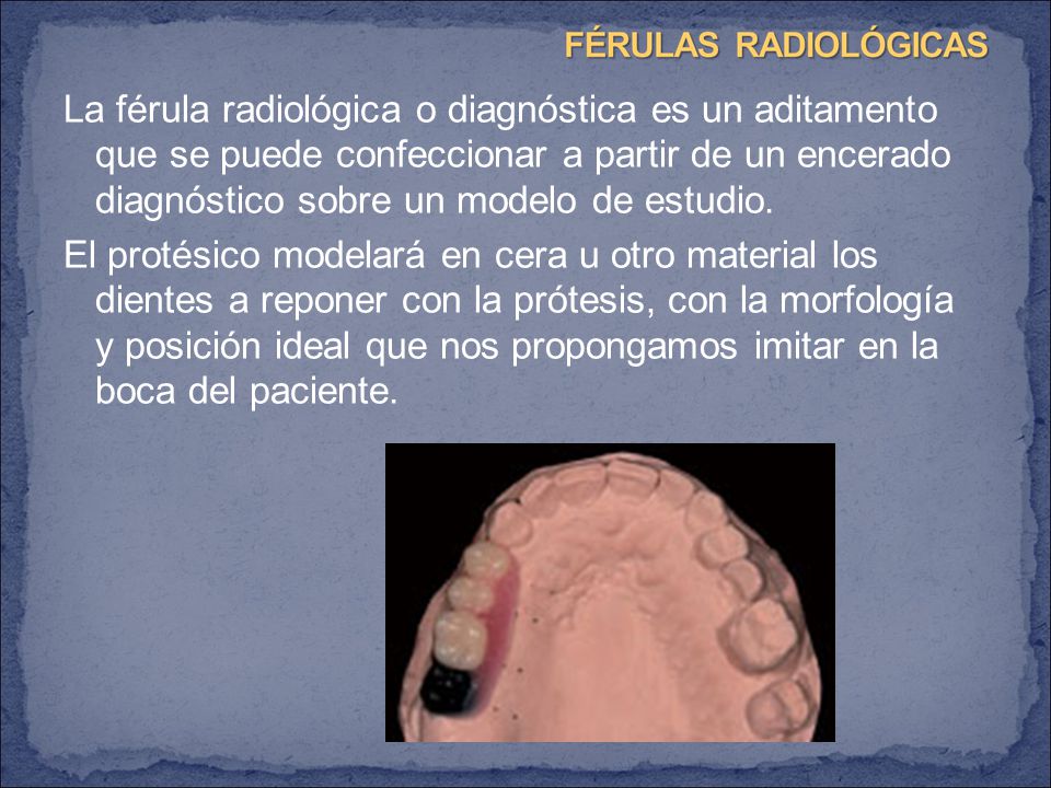 La férula radiológica o diagnóstica es un aditamento que se puede confeccionar a partir de un encerado diagnóstico sobre un modelo de estudio.