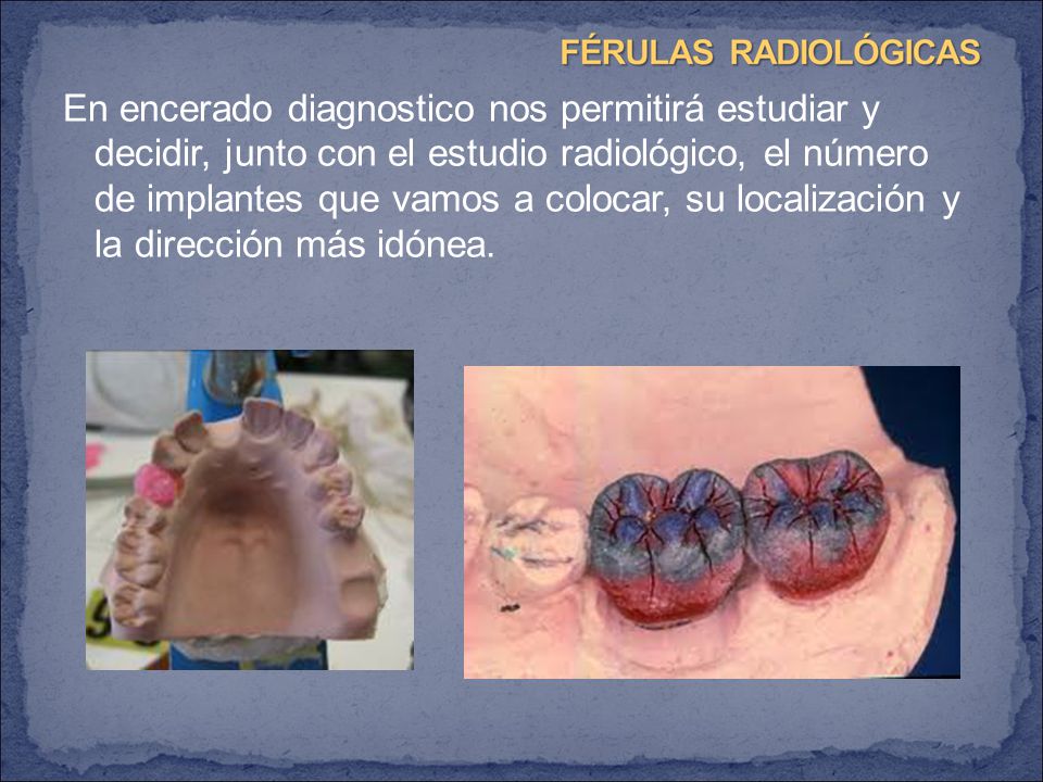 En encerado diagnostico nos permitirá estudiar y decidir, junto con el estudio radiológico, el número de implantes que vamos a colocar, su localización y la dirección más idónea.