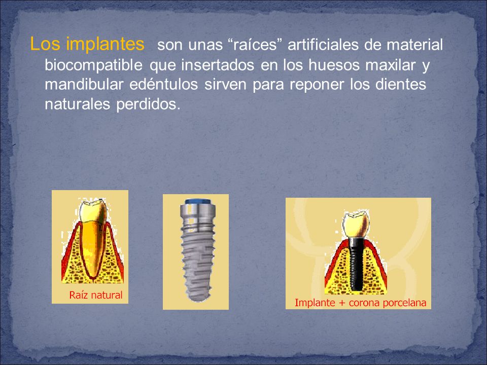 Los implantes son unas raíces artificiales de material biocompatible que insertados en los huesos maxilar y mandibular edéntulos sirven para reponer los dientes naturales perdidos.