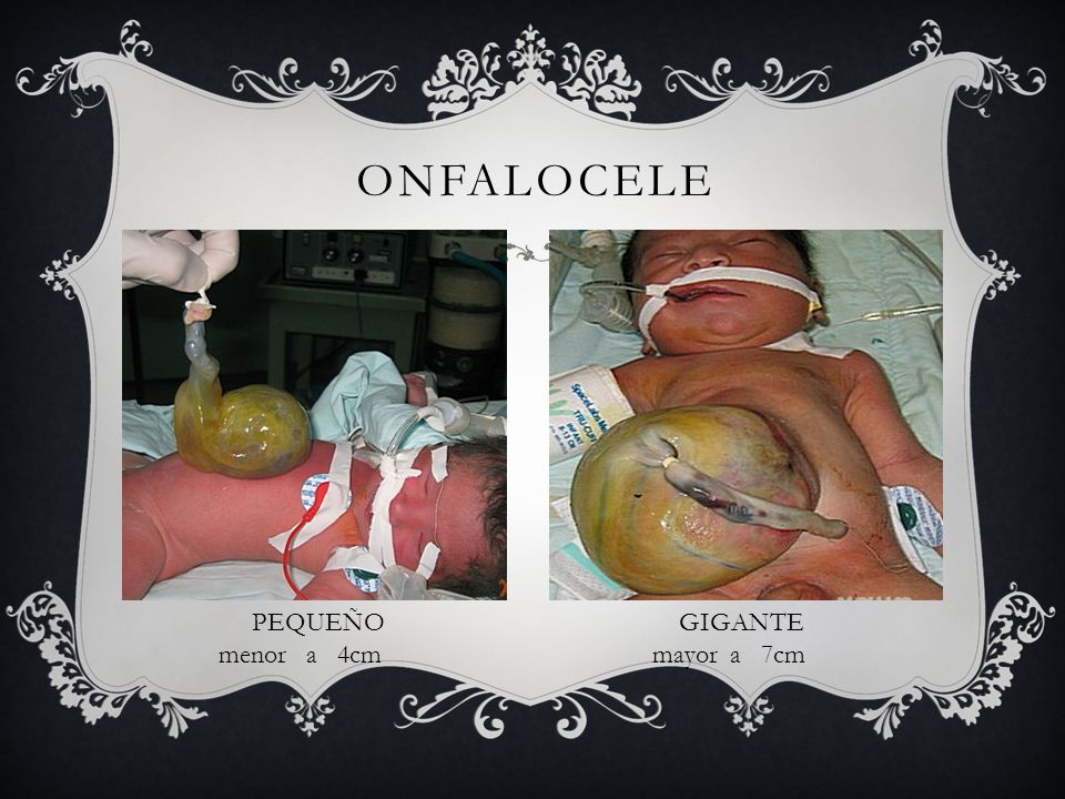 ONFALOCELE PEQUEÑO menor a 4cm GIGANTE mayor a 7cm