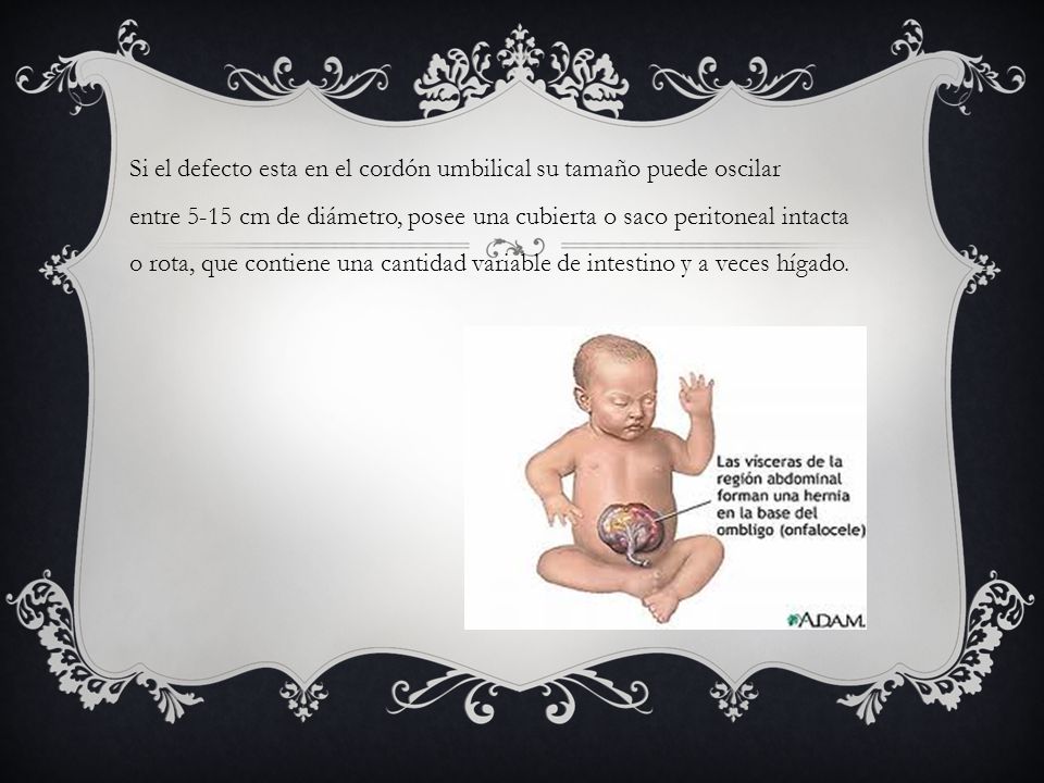 Si el defecto esta en el cordón umbilical su tamaño puede oscilar entre 5-15 cm de diámetro, posee una cubierta o saco peritoneal intacta o rota, que contiene una cantidad variable de intestino y a veces hígado.