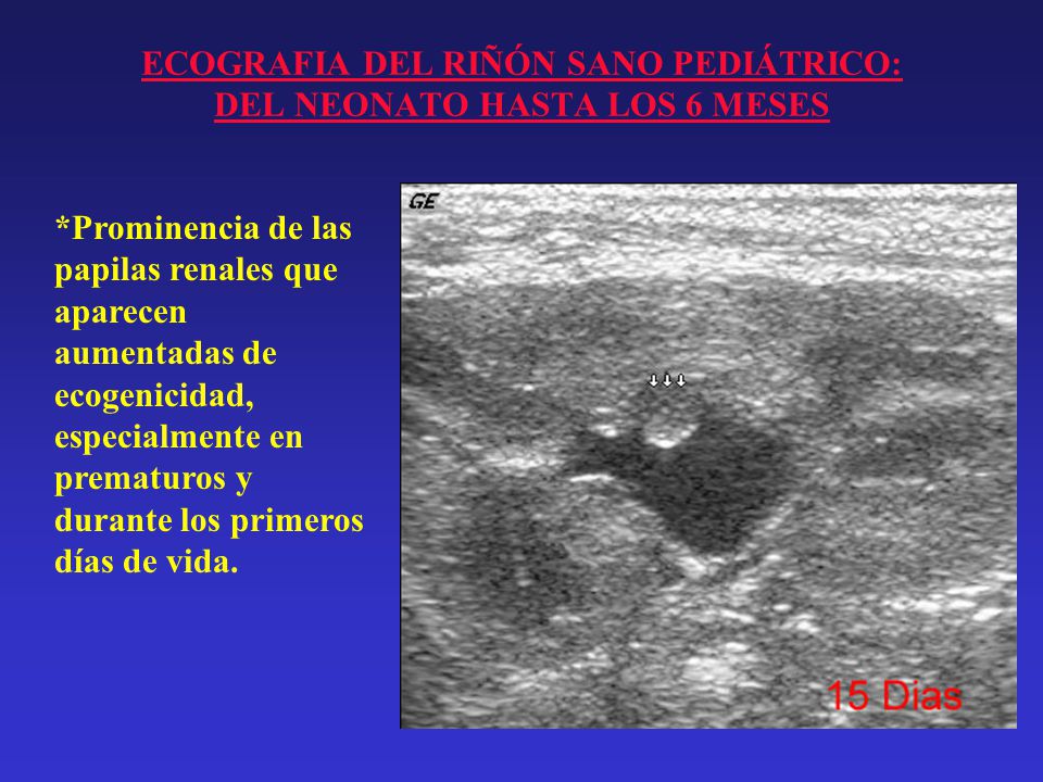 ECOGRAFIA DEL RIÑÓN SANO PEDIÁTRICO: DEL NEONATO HASTA LOS 6 MESES