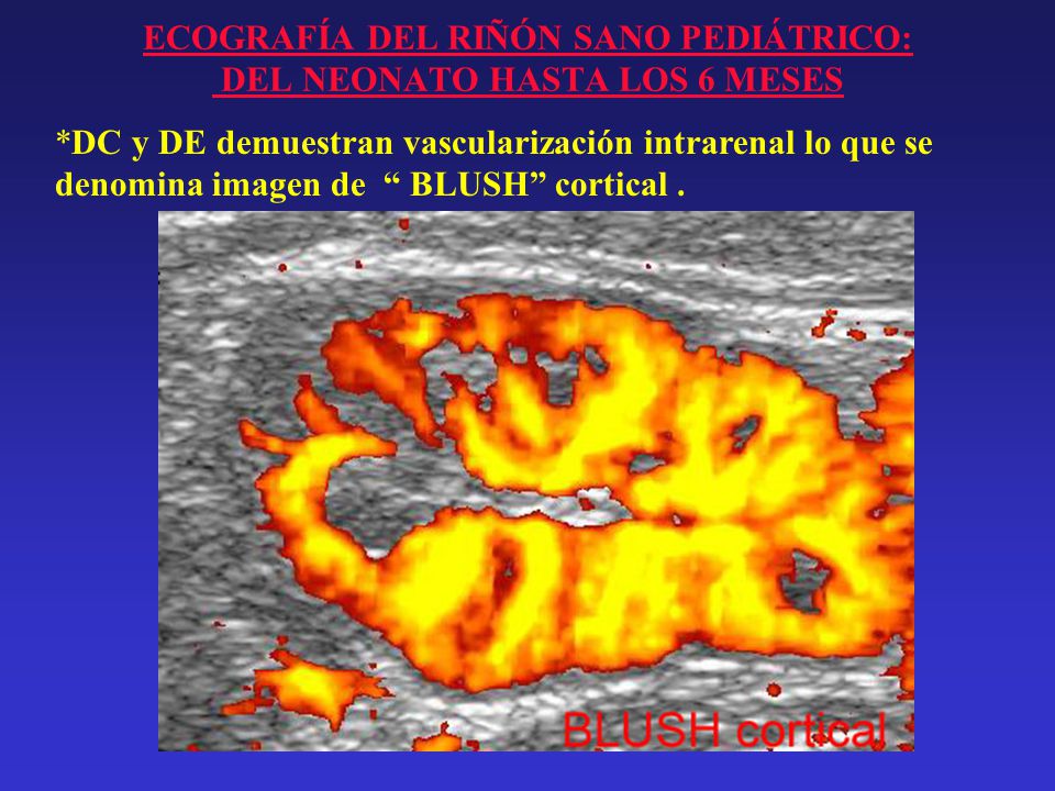 ECOGRAFÍA DEL RIÑÓN SANO PEDIÁTRICO: DEL NEONATO HASTA LOS 6 MESES