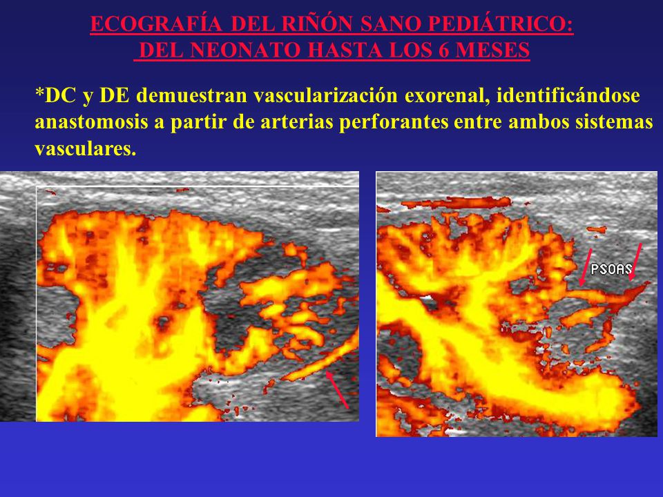 ECOGRAFÍA DEL RIÑÓN SANO PEDIÁTRICO: DEL NEONATO HASTA LOS 6 MESES