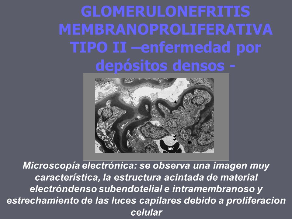 GLOMERULONEFRITIS MEMBRANOPROLIFERATIVA TIPO II –enfermedad por depósitos densos -