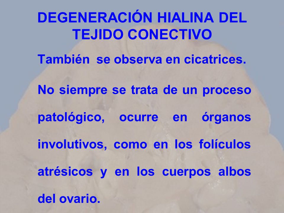 DEGENERACIÓN HIALINA DEL TEJIDO CONECTIVO