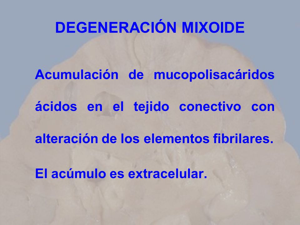 DEGENERACIÓN MIXOIDE Acumulación de mucopolisacáridos ácidos en el tejido conectivo con alteración de los elementos fibrilares.
