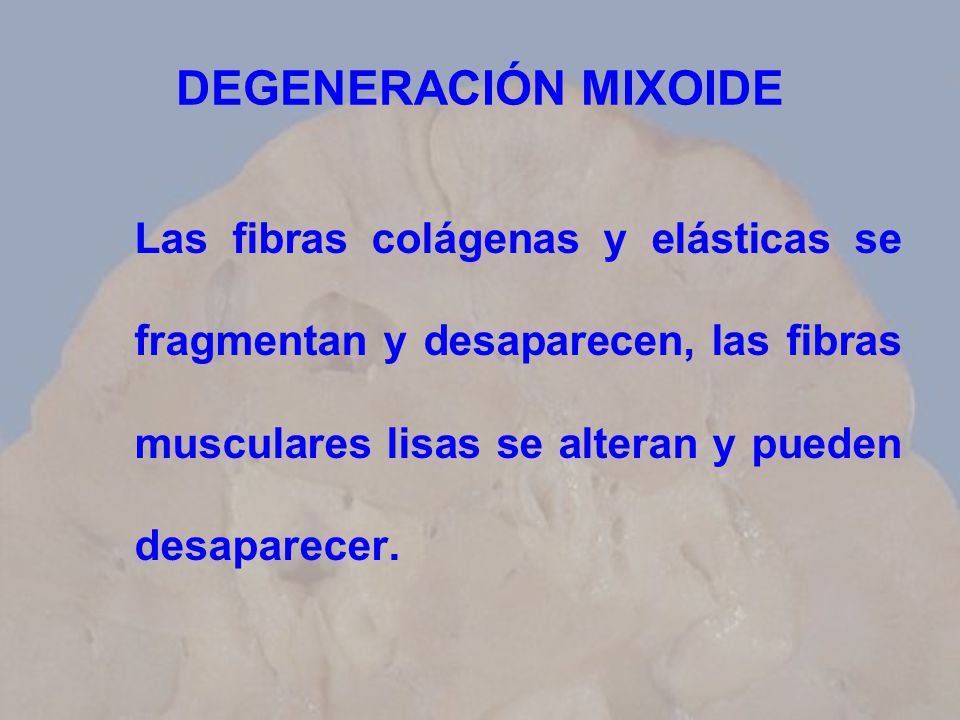 DEGENERACIÓN MIXOIDE Las fibras colágenas y elásticas se fragmentan y desaparecen, las fibras musculares lisas se alteran y pueden desaparecer.