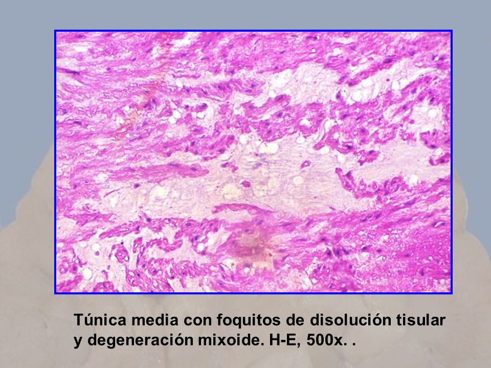 Túnica media con foquitos de disolución tisular y degeneración mixoide
