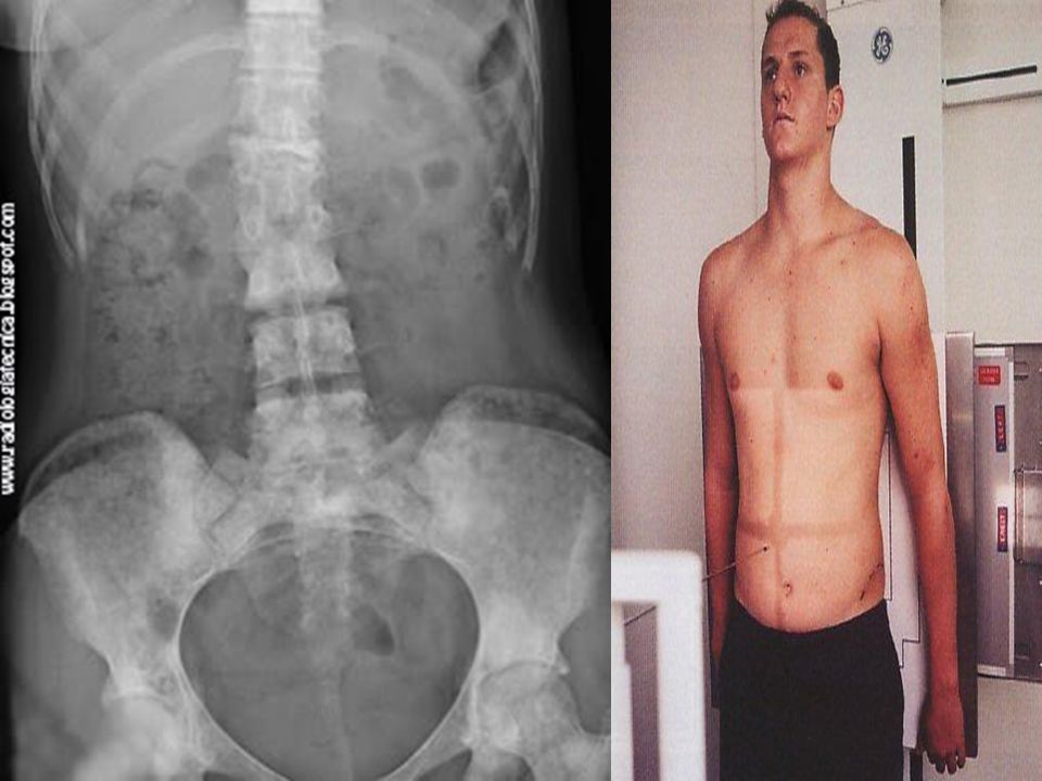 AP bipedestación Se coloca una placa de 35 a 43cm en la bandeja del bucky. Posición del paciente.