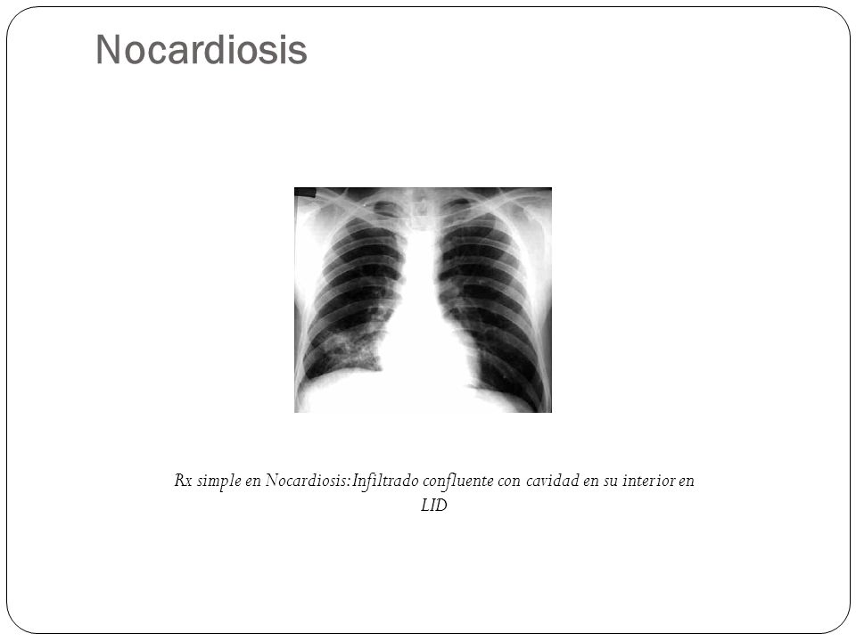 Nocardiosis Rx simple en Nocardiosis: Infiltrado confluente con cavidad en su interior en LID