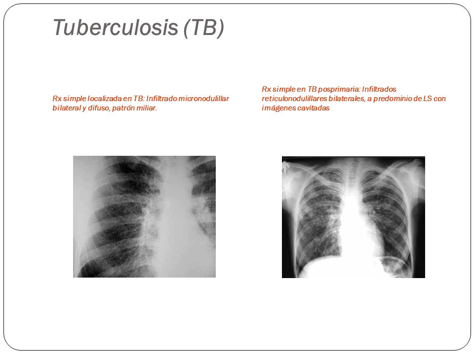 Tuberculosis (TB) Rx simple localizada en TB: Infiltrado micronodulillar bilateral y difuso, patrón miliar.