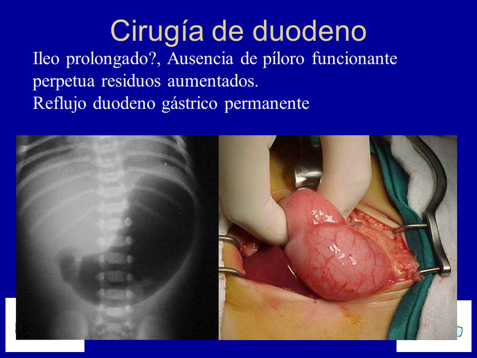 Cirugía de duodeno Ileo prolongado , Ausencia de píloro funcionante